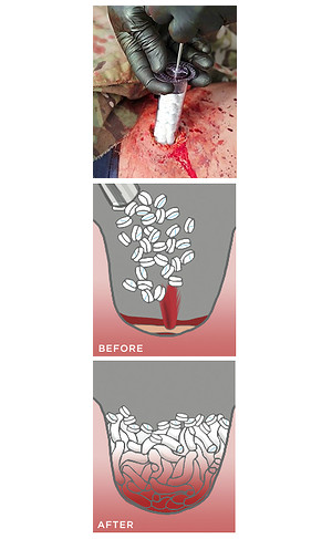 Illustration for article titled This sponge-filled syringe can plug a gunshot wound in just 15 seconds